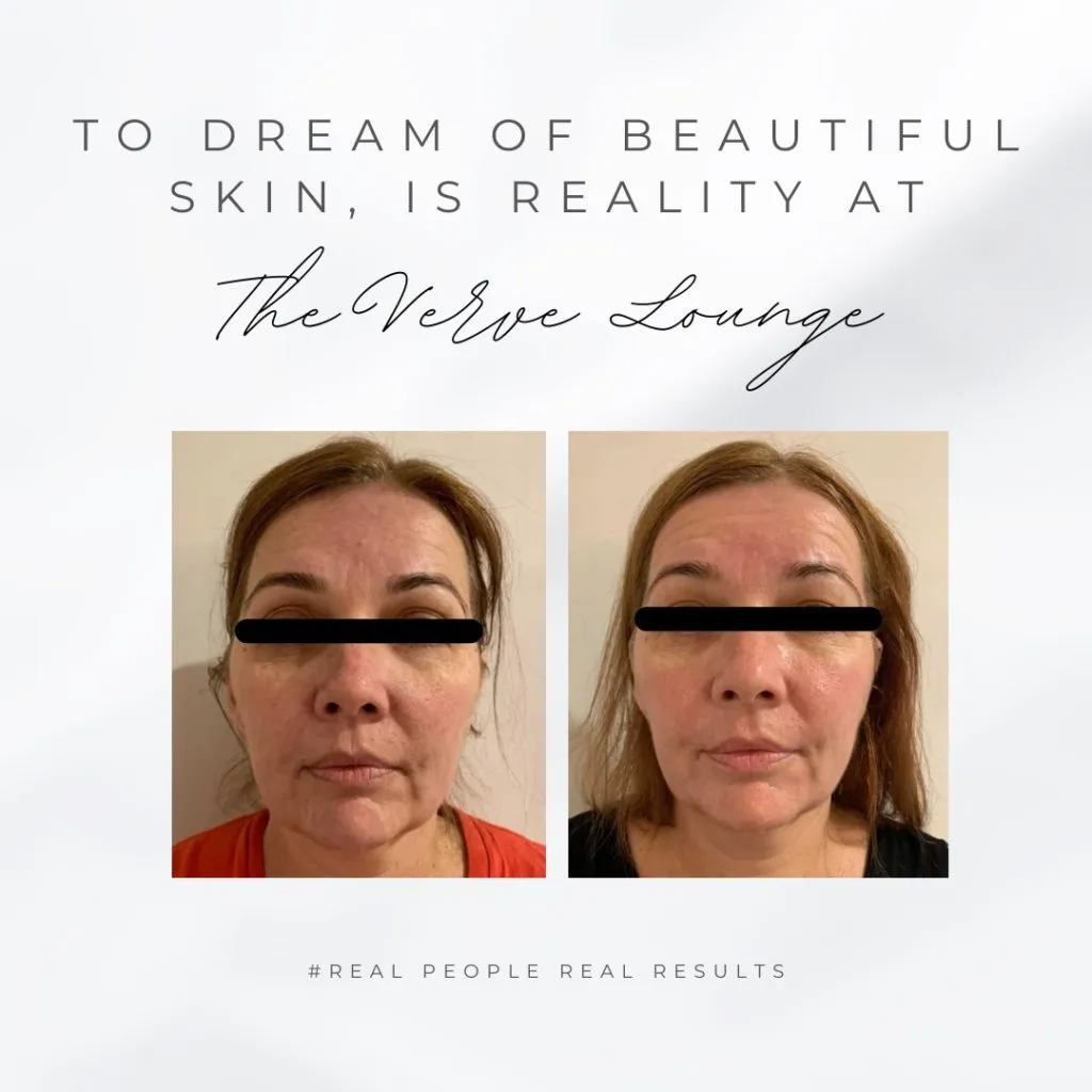 HIFU-Skin2-1024x1024-1