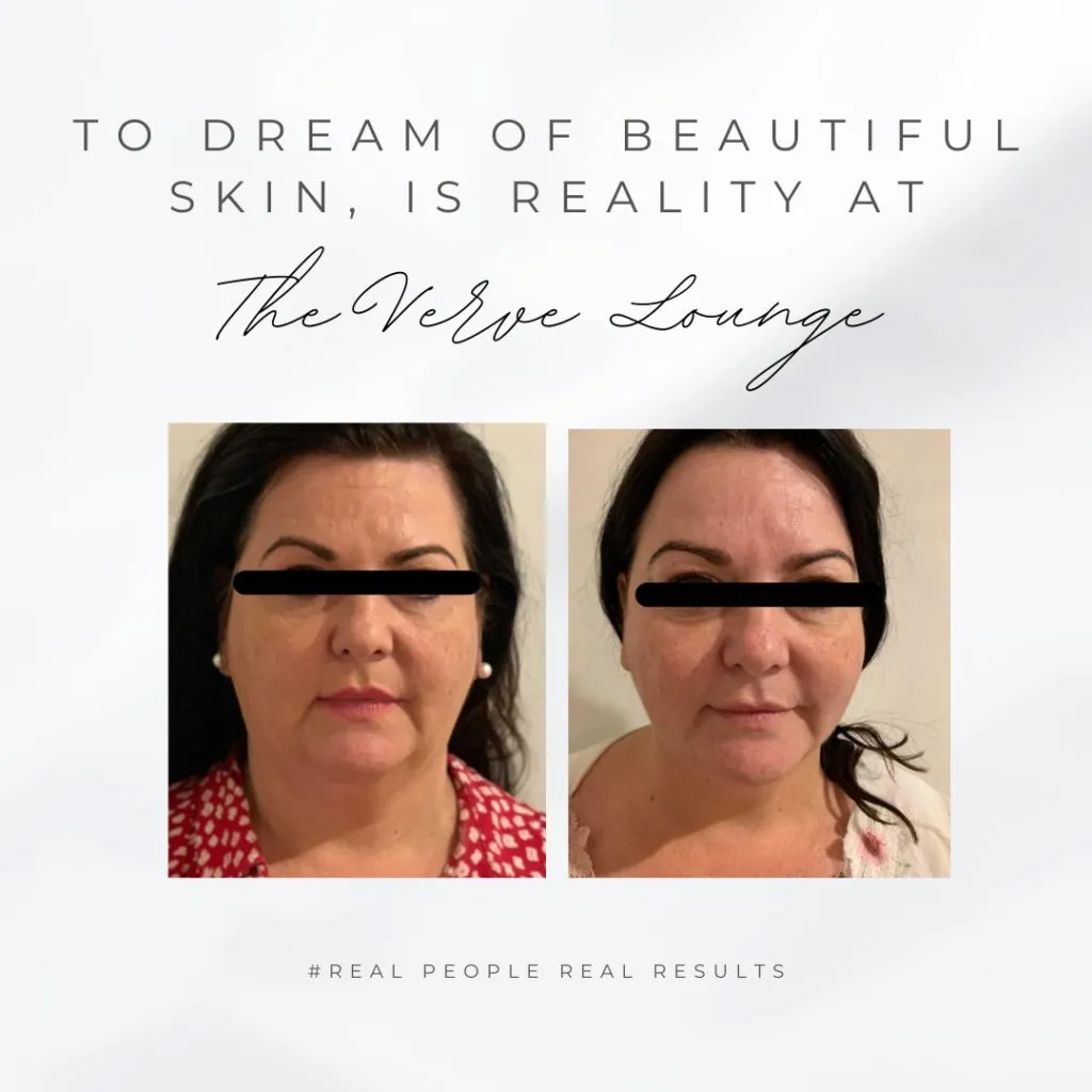 HIFU-Skin4-1024x1024-1